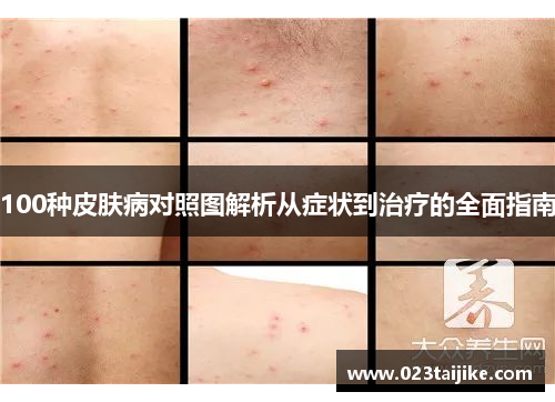 100种皮肤病对照图解析从症状到治疗的全面指南